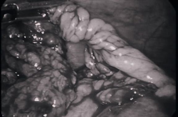 Нижегородские хирурги прооперировали ребенка с редчайшей патологией - фото 1